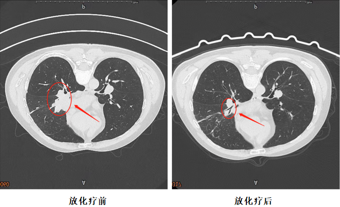 【警惕】肺结节恶化成癌！竟……
