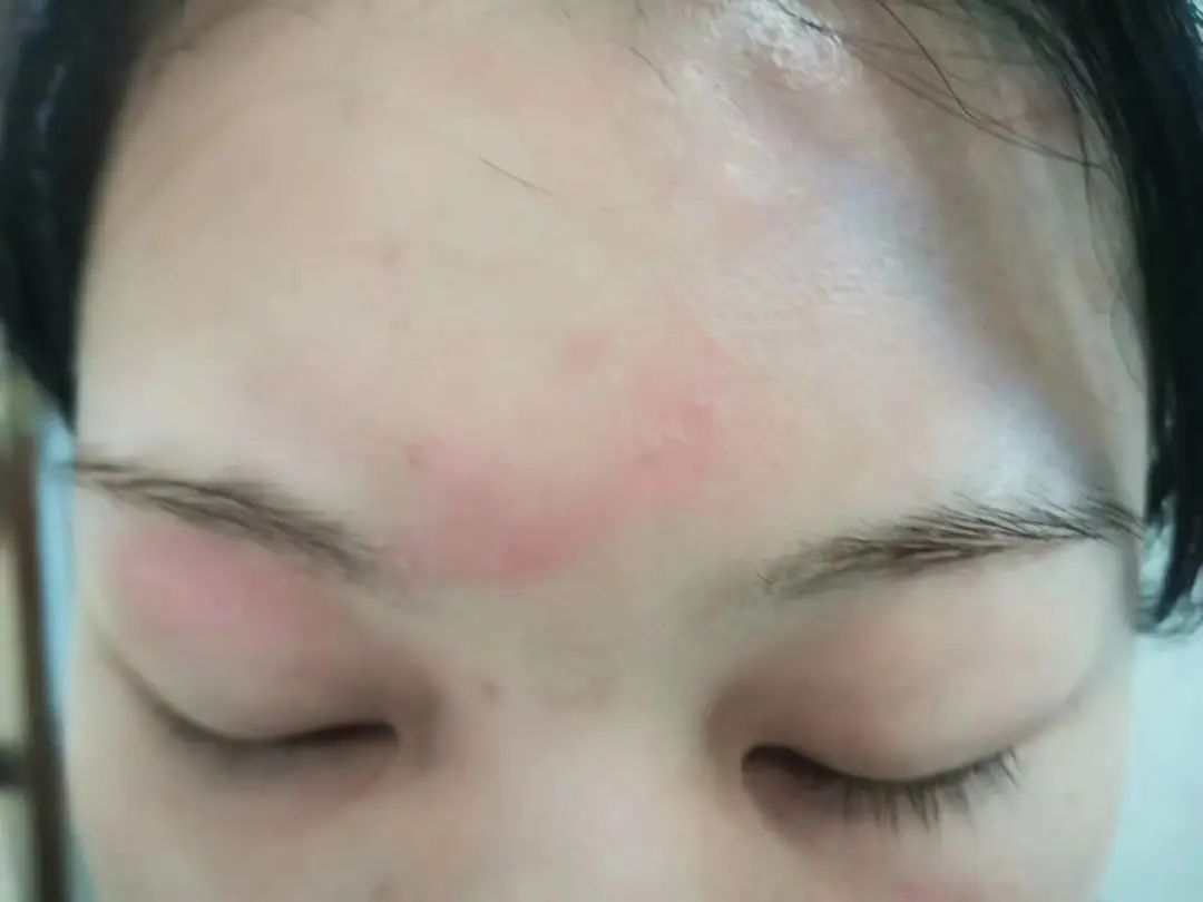 泸州女子差点毁容，竟是被虫子“泼硫酸”......